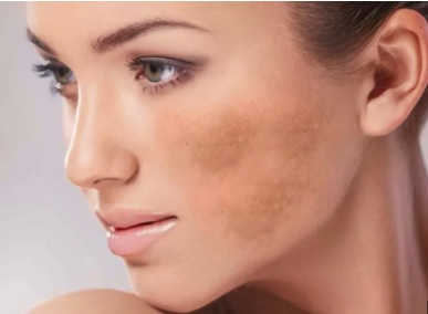 O que causa melasma e por que ele volta? Entenda as causas