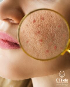 Dermatologista avaliando paciente para definir o melhor tratamento para acne