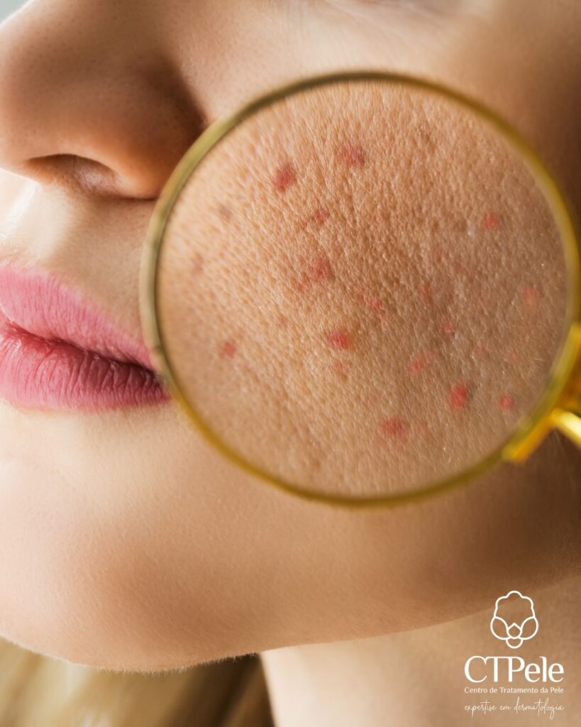 Dermatologista avaliando paciente para definir o melhor tratamento para acne