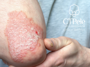 Dermatologista avaliando paciente com psoríase para definir o tratamento