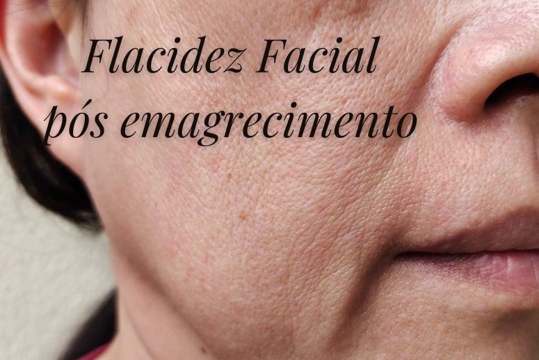 Flacidez facial após emagrecimento com canetas: por que acontece e como tratar?